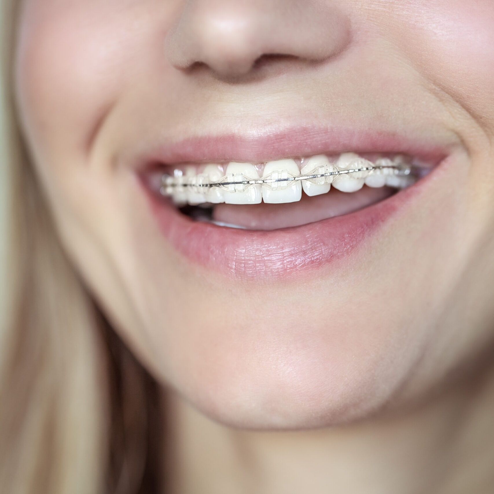 clear aligners chattanooga